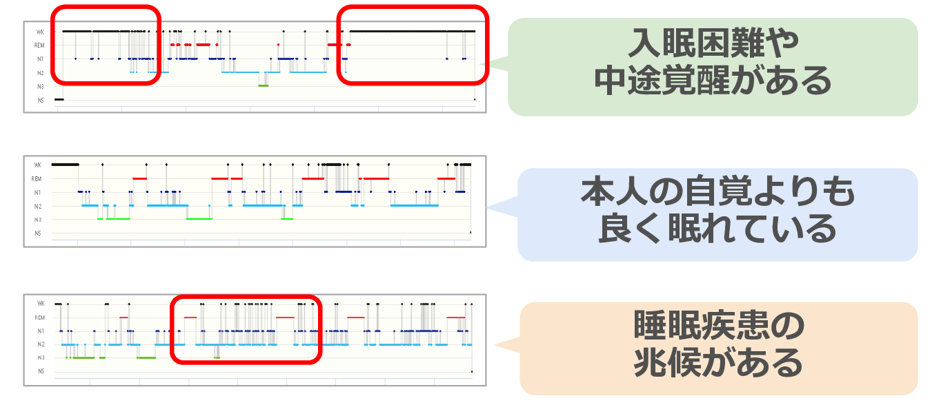 脳波グラフ